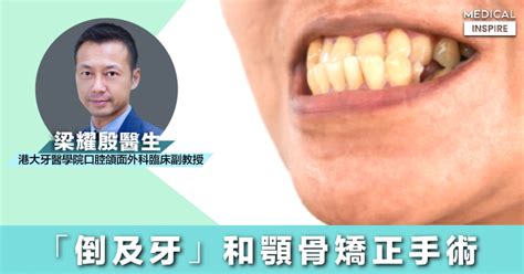 上顎突出面相|「倒及牙」和顎骨矯正手術｜香港大學牙醫學院 – Medical Inspir